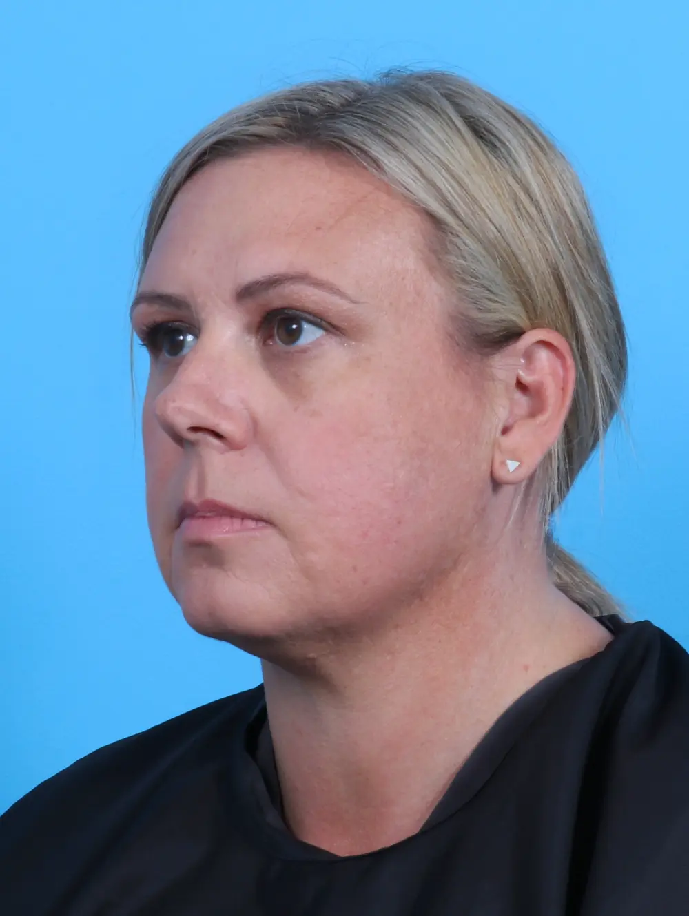 Eyelid Surgery Patient Photo - Case 26957 - after view-1