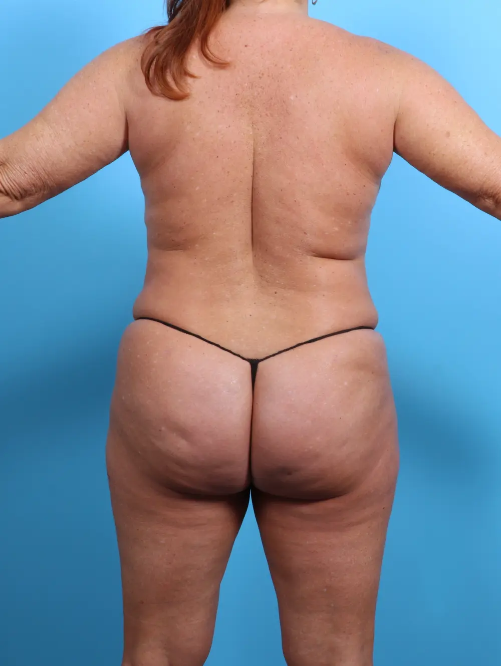 Breast Lift/Reduction w/o Implants Patient Photo - Case 26967 - after view-3