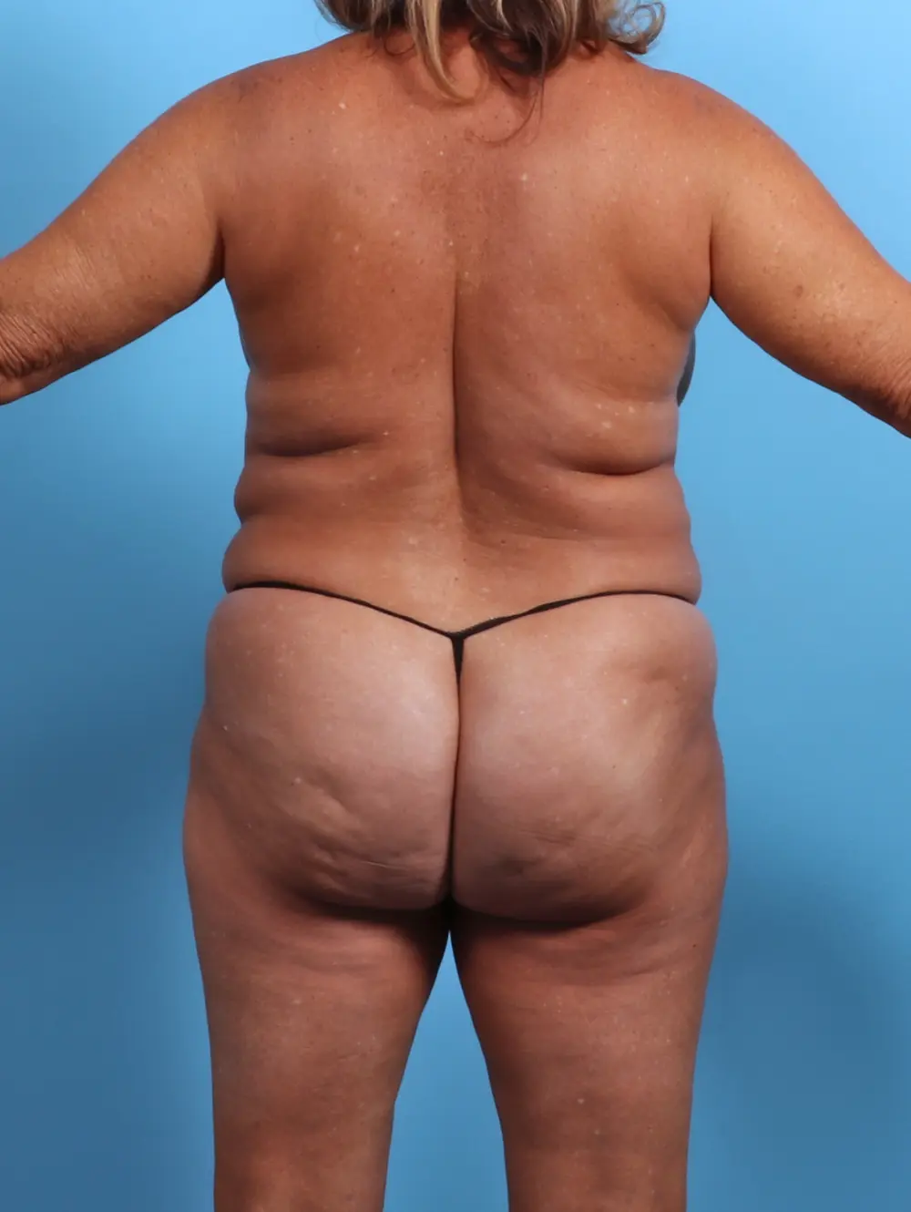 Breast Lift/Reduction w/o Implants Patient Photo - Case 26967 - before view-3