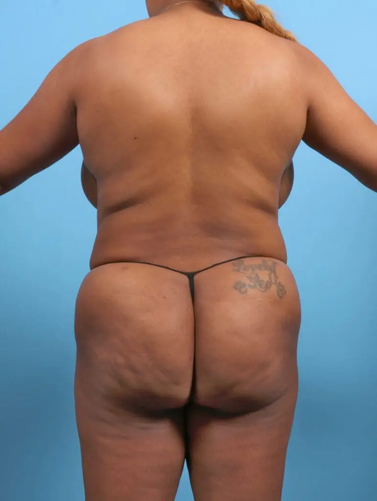 Brazilian Butt Lift - Case 26977 - After