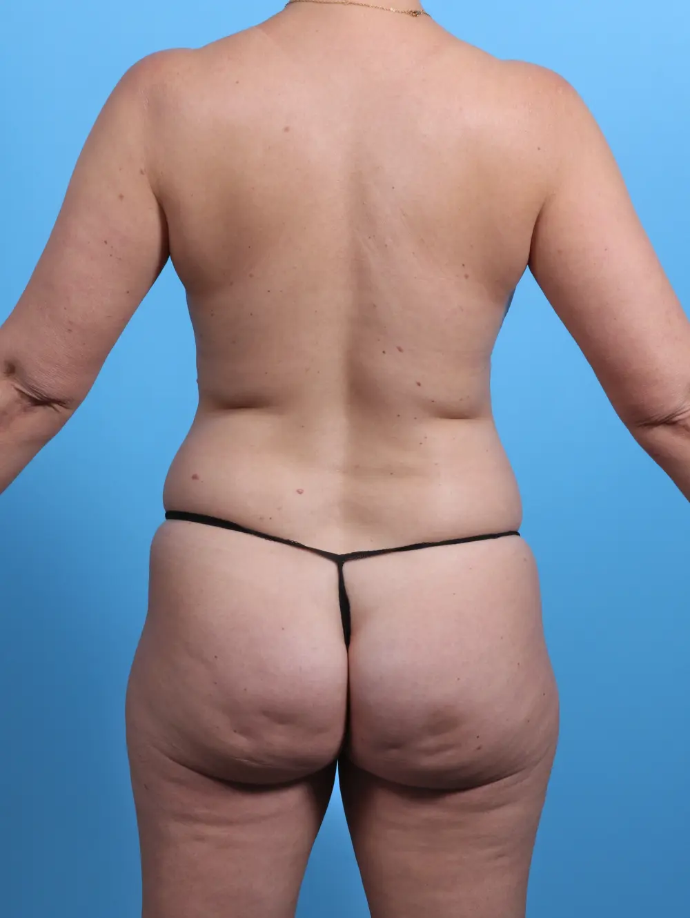 Breast Lift/Reduction with Implants Patient Photo - Case 26993 - before view-3