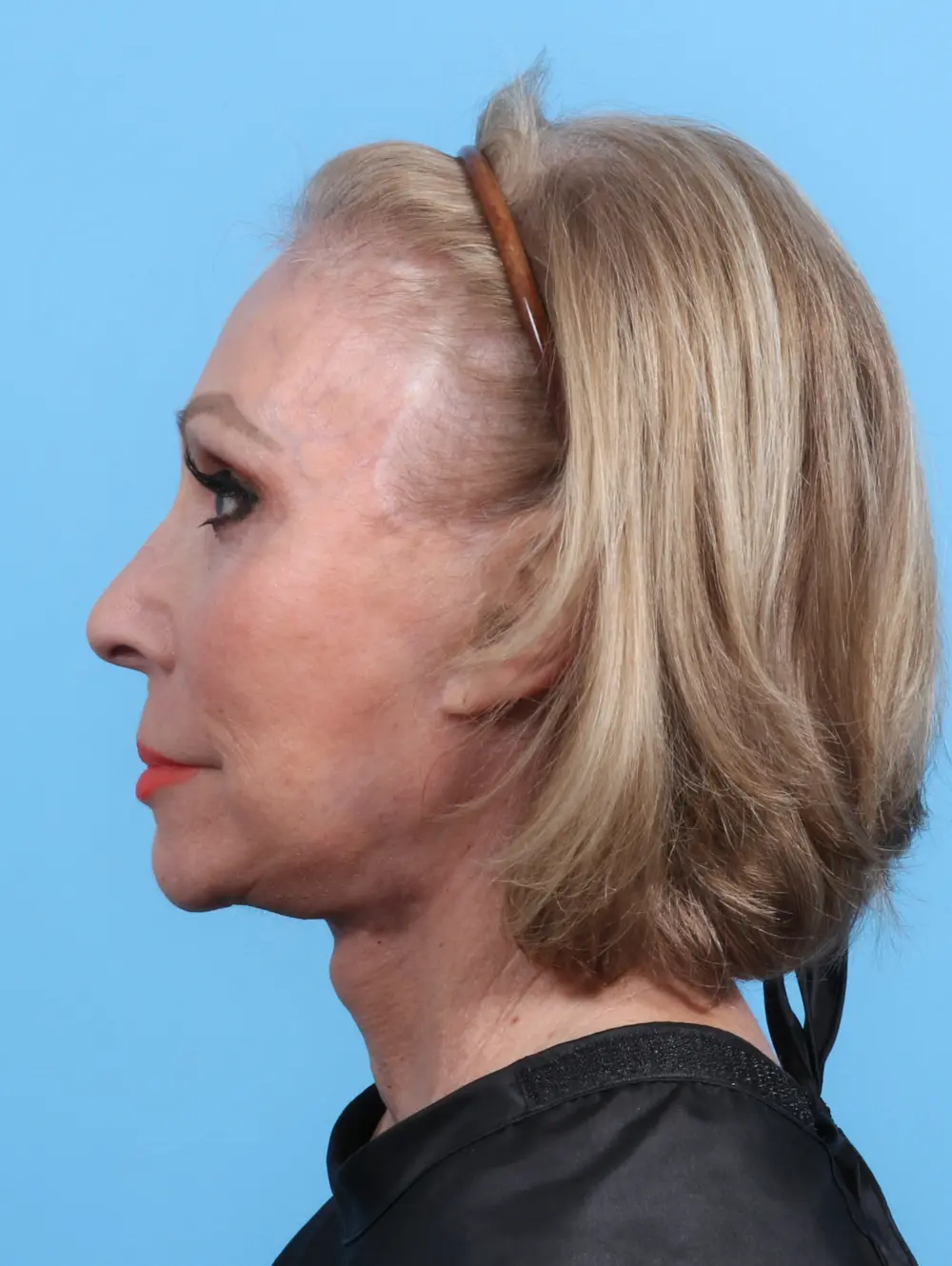 Facelift / Neck Lift Patient Photo - Case 27003 - after view-2