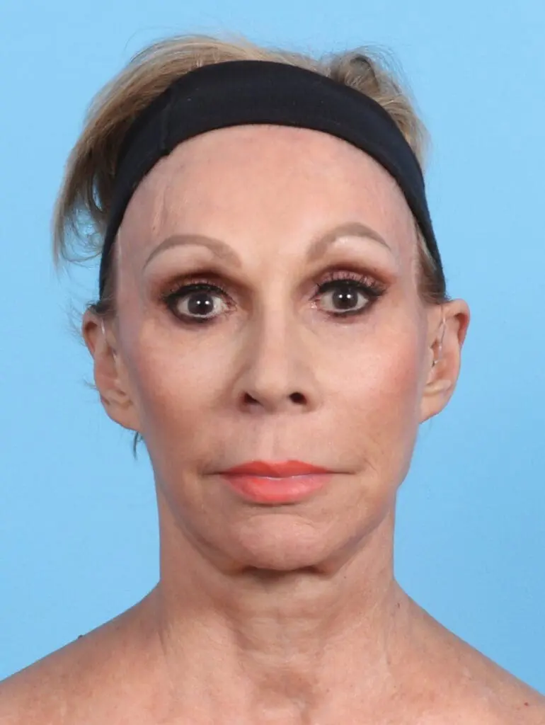 Facelift / Neck Lift - Case 27003 - Before