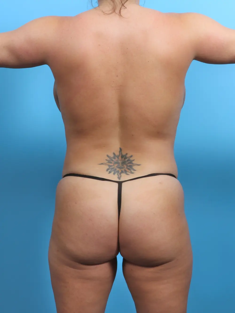 After Brazilian Butt Lift