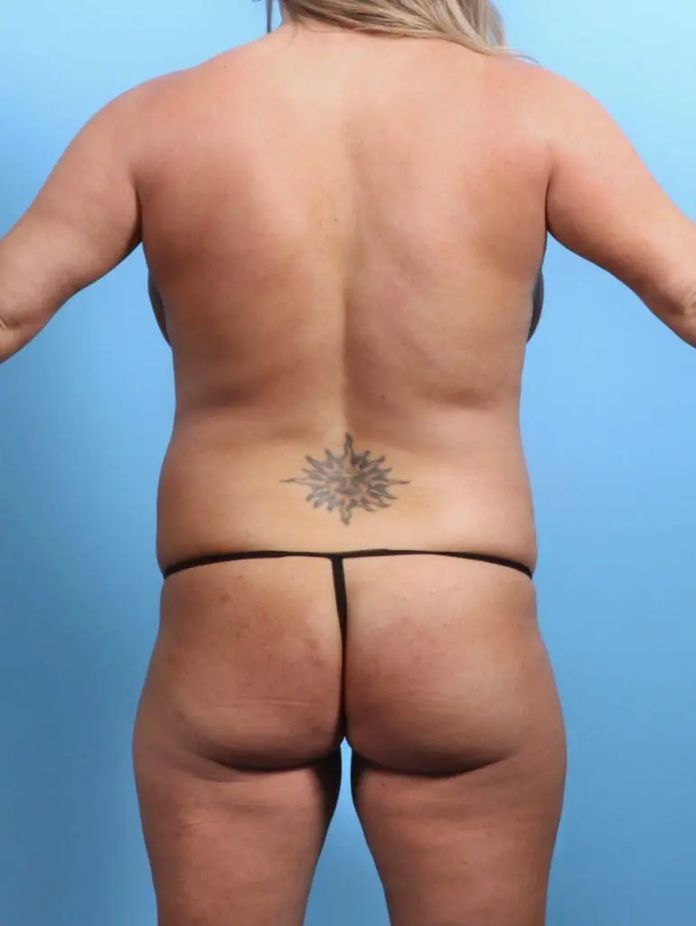 Brazilian Butt Lift - Case 27011 - Before