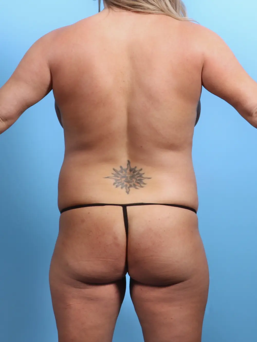 Before Brazilian Butt Lift