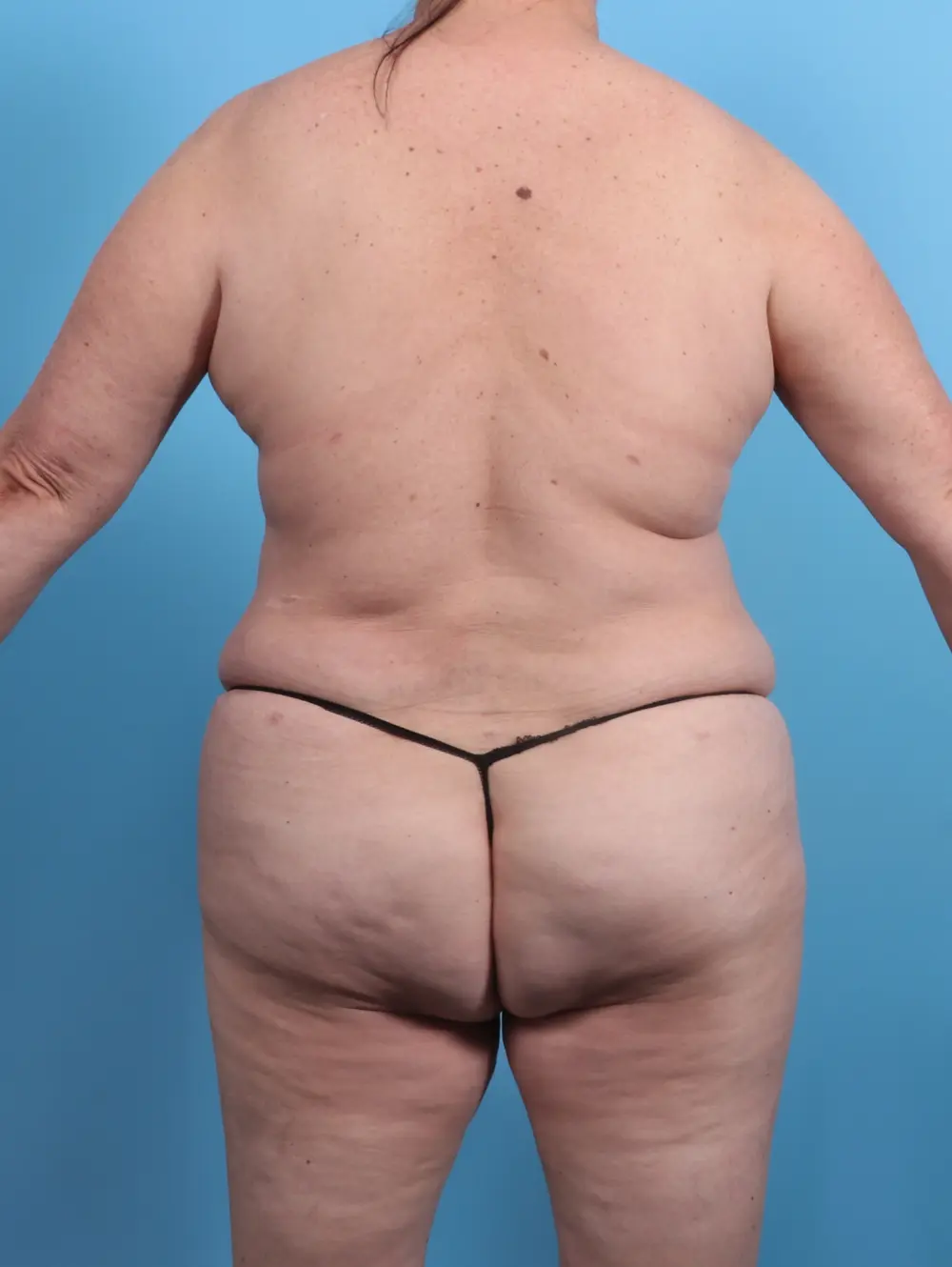 Breast Lift/Reduction w/o Implants Patient Photo - Case 27015 - after view-3