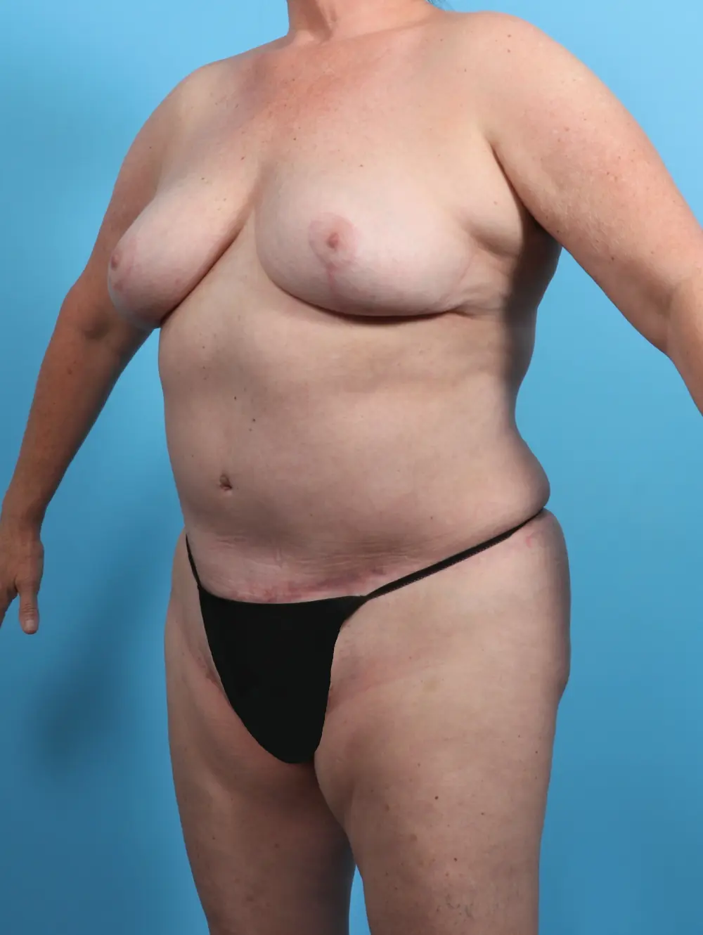 Breast Lift/Reduction w/o Implants Patient Photo - Case 27015 - after view-1