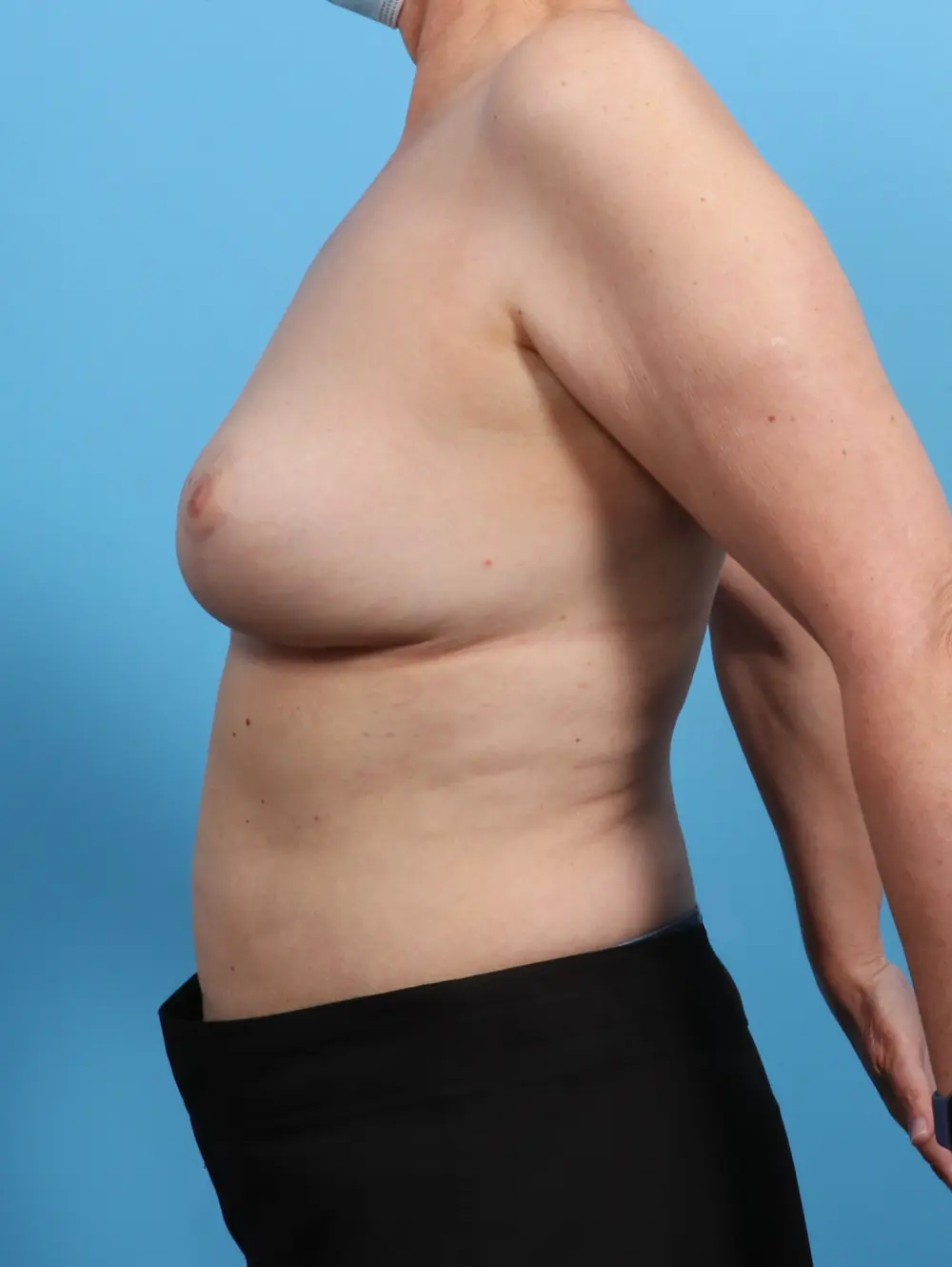 Breast Lift/Reduction w/o Implants Patient Photo - Case 27025 - after view-2