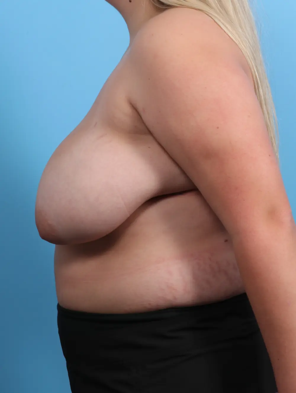 Breast Lift/Reduction w/o Implants Patient Photo - Case 27042 - before view-2