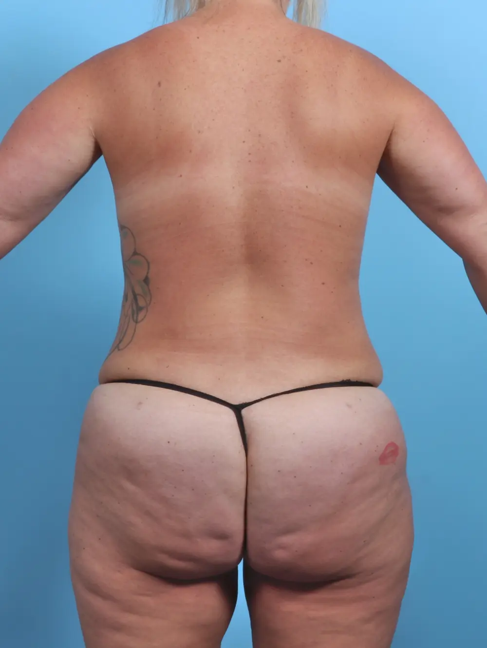 Breast Lift/Reduction with Implants Patient Photo - Case 27050 - after view-3