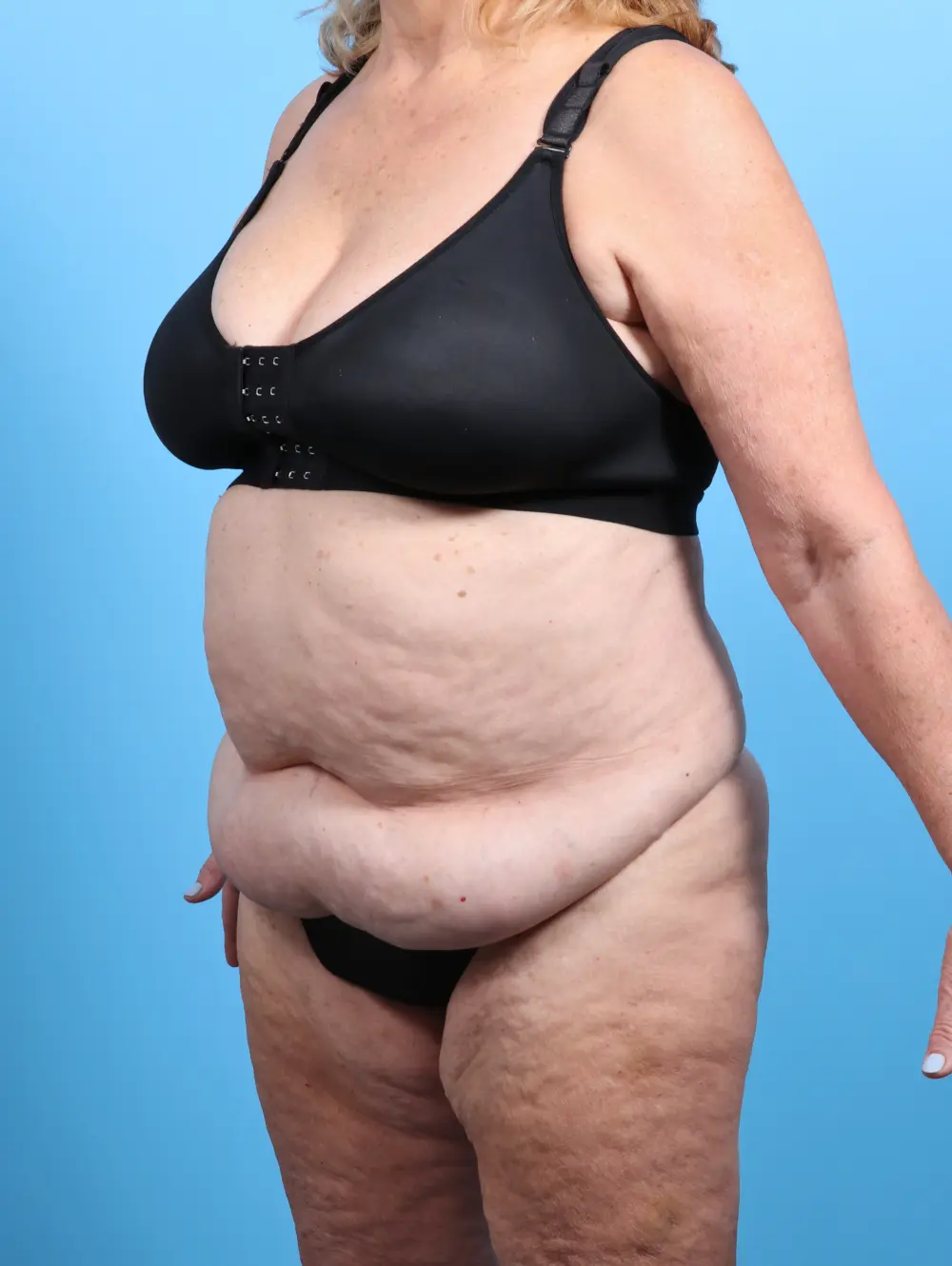 Tummy Tuck Patient Photo - Case 27069 - before view-1