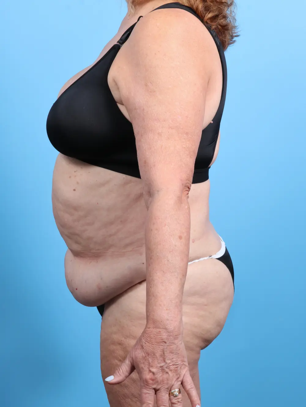 Tummy Tuck Patient Photo - Case 27069 - before view-2