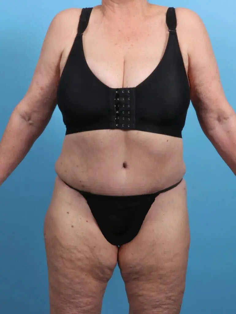 Tummy Tuck - Case 27069 - After