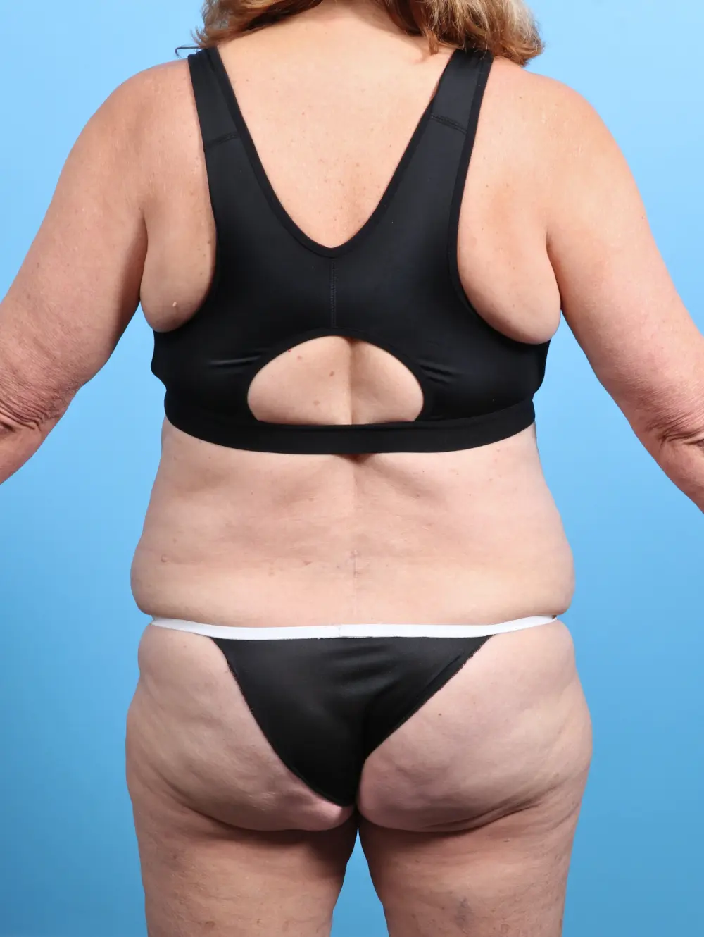 Tummy Tuck Patient Photo - Case 27069 - before view-3