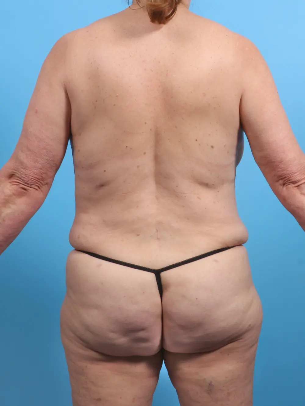 Tummy Tuck Patient Photo - Case 27069 - after view-3