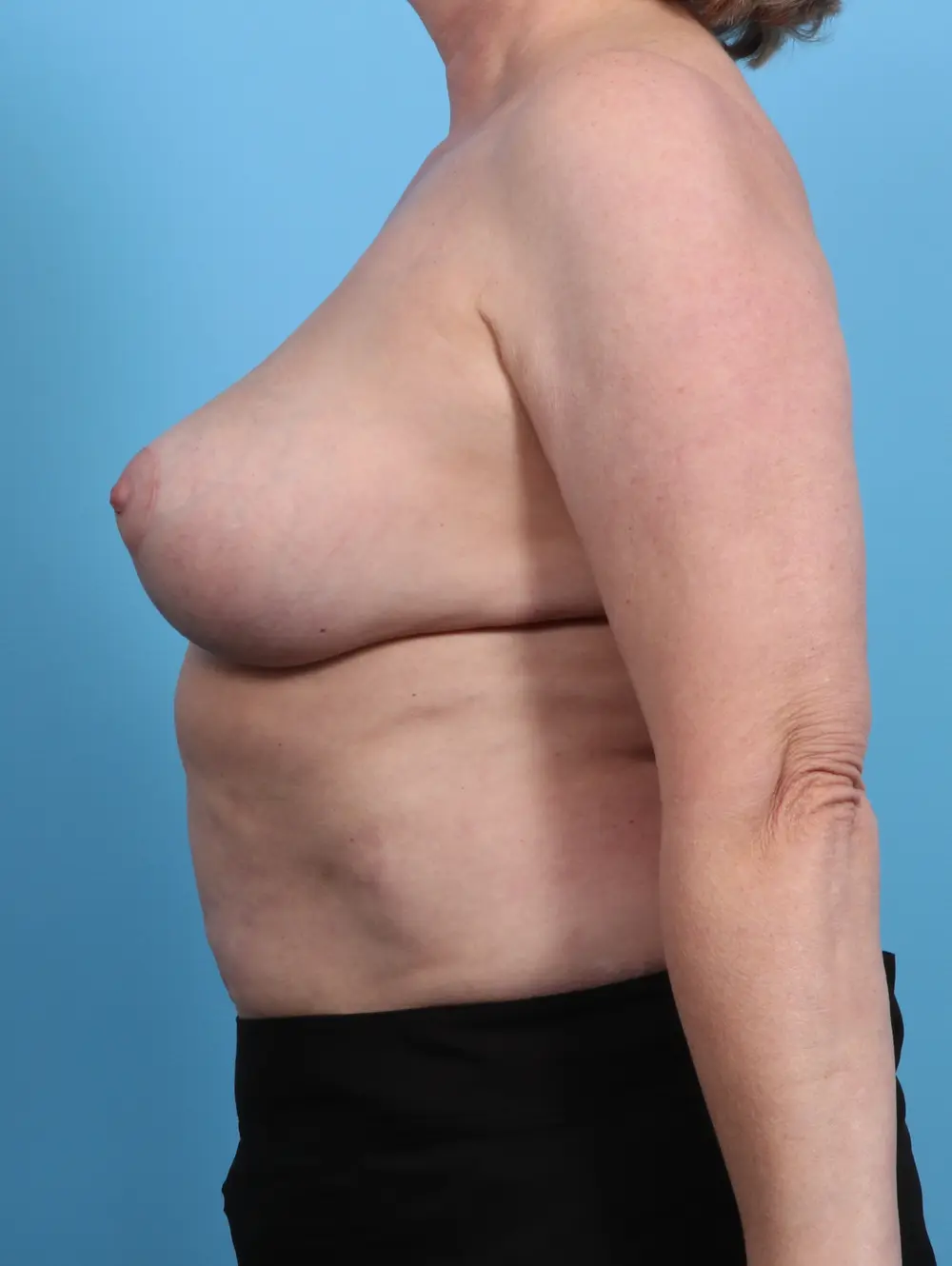 Breast Lift/Reduction w/o Implants Patient Photo - Case 27250 - after view-2
