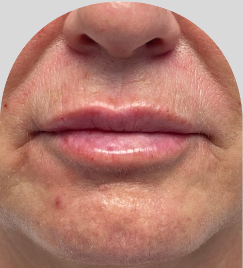 Lip Fillers - Case 27344 - After