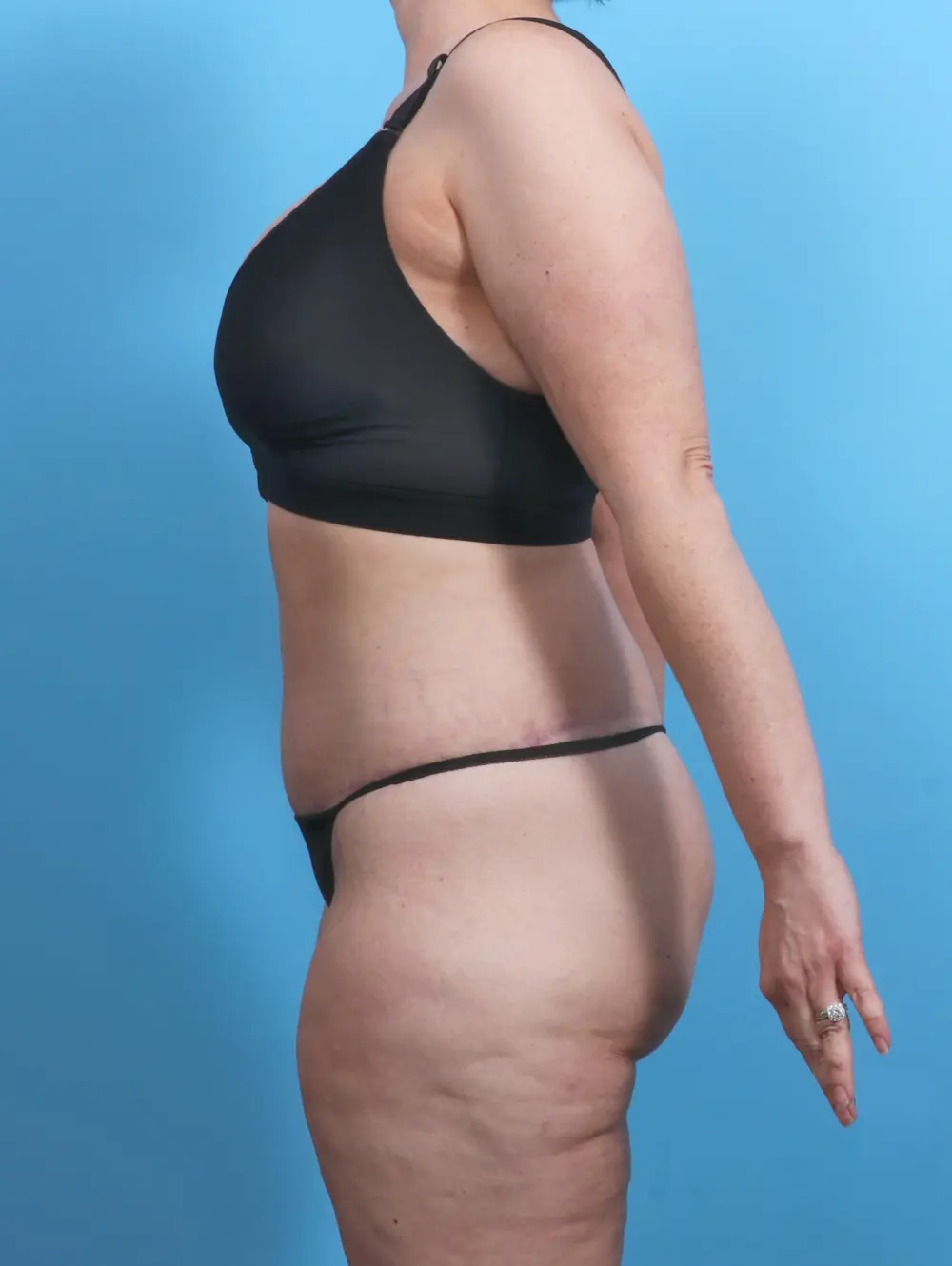 After Weight Loss Patient Photo - Case 27353 - after view-2