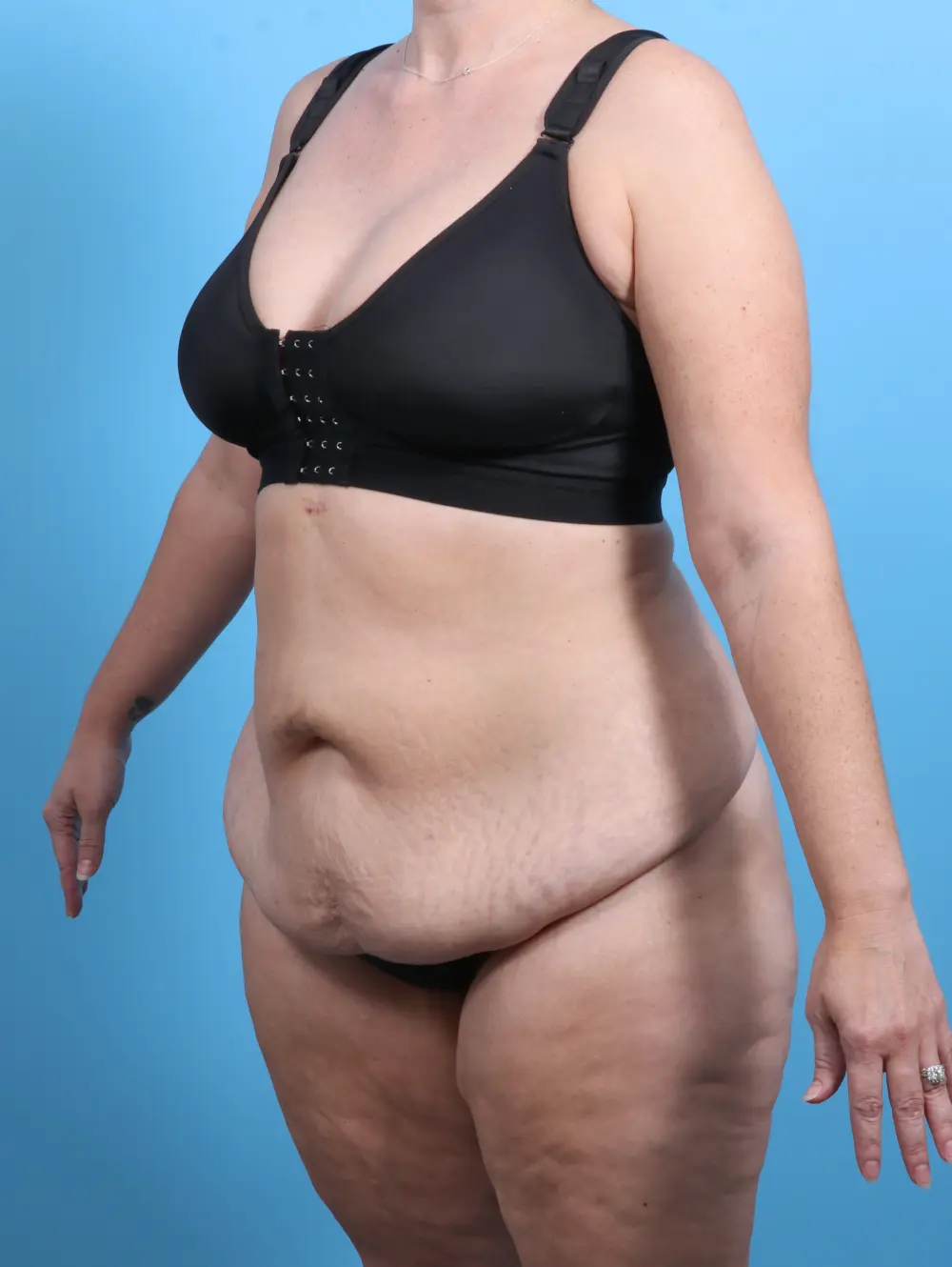 After Weight Loss Patient Photo - Case 27353 - before view-1