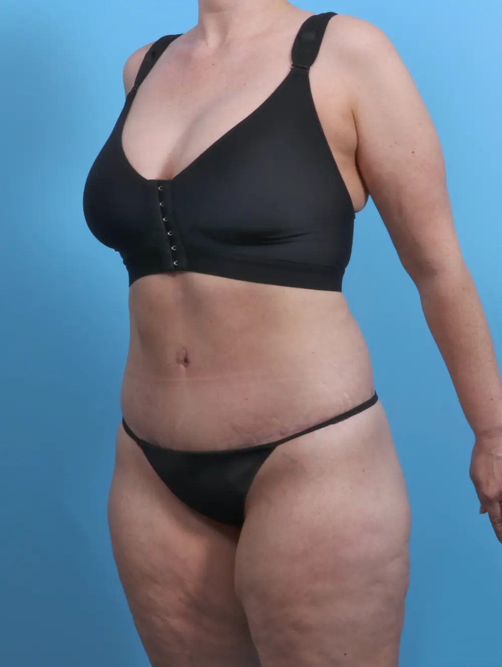 After Weight Loss Patient Photo - Case 27353 - after view-1