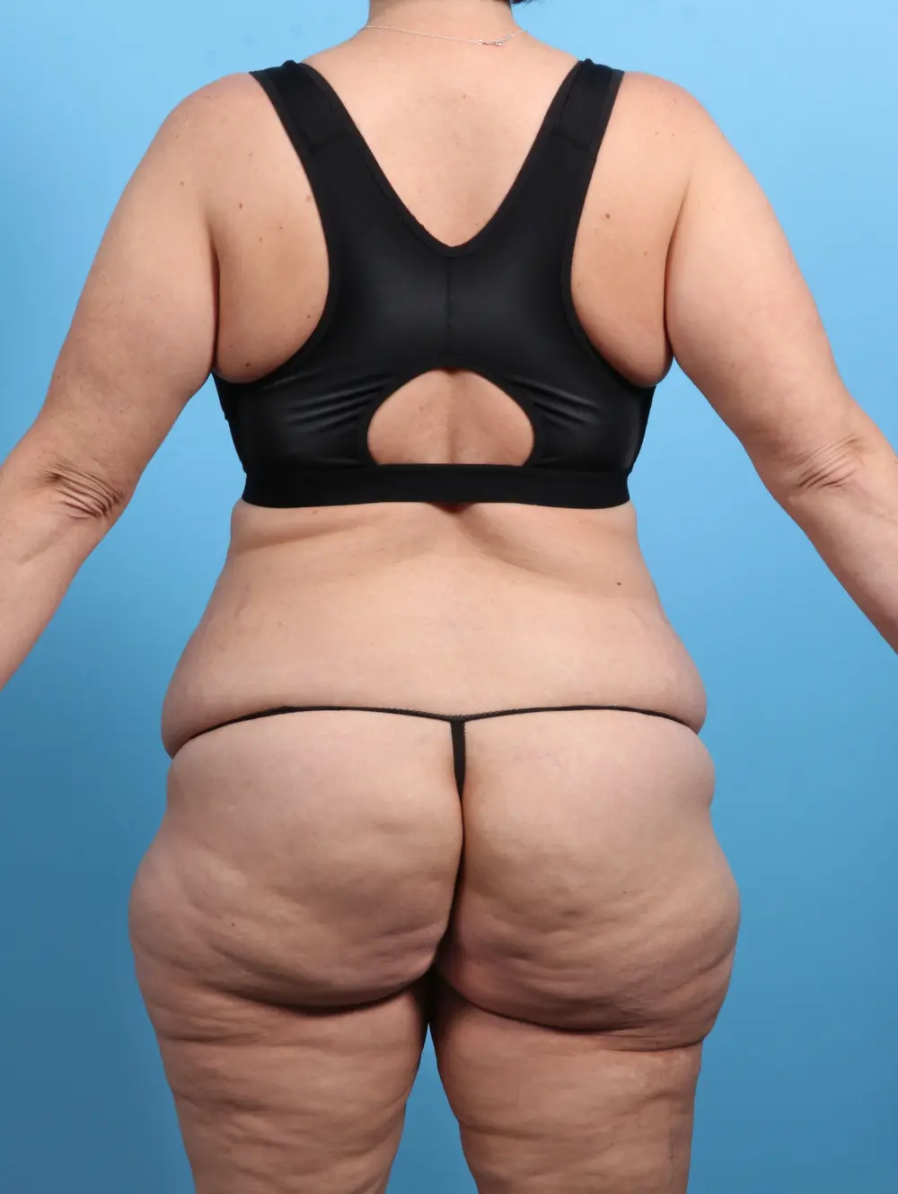 After Weight Loss Patient Photo - Case 27353 - before view-3