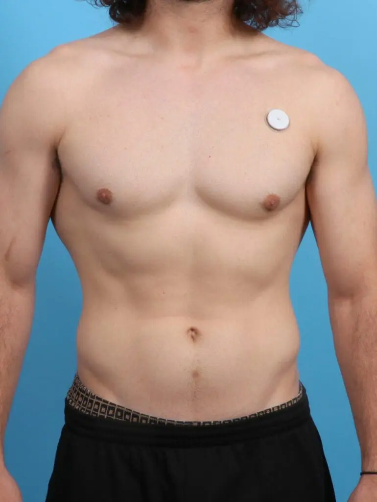Gynecomastia - Case 27383 - After
