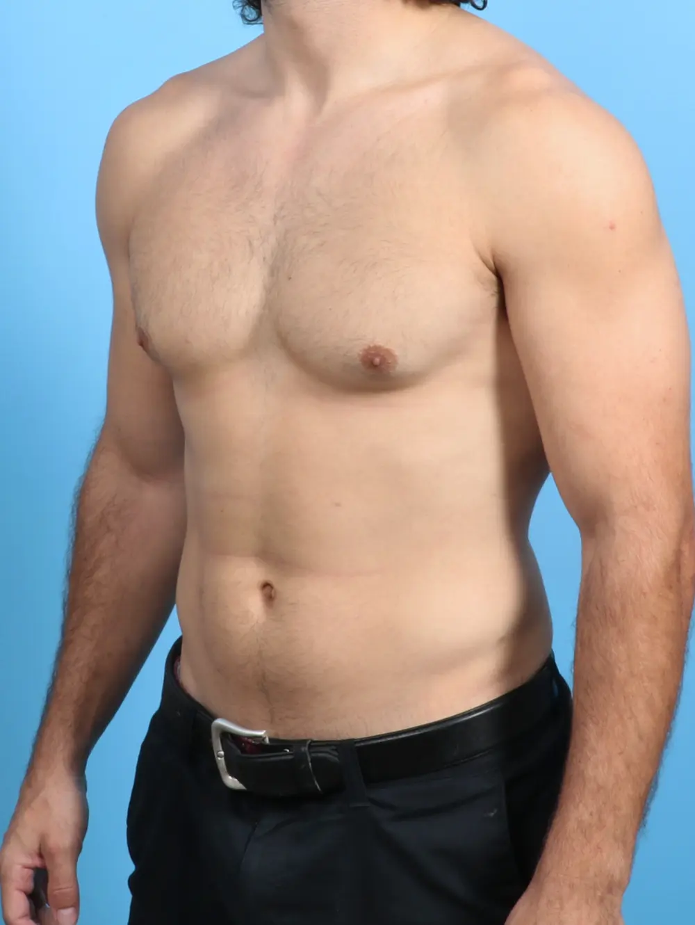 Gynecomastia Patient Photo - Case 27383 - before view-1