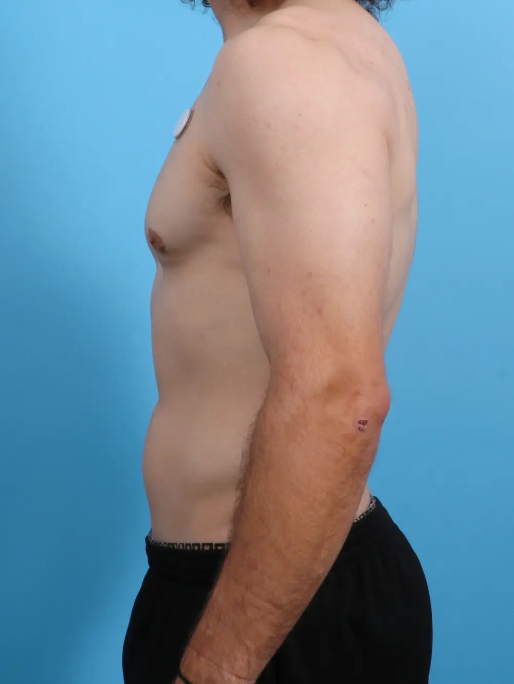 Gynecomastia Patient Photo - Case 27383 - after view-2