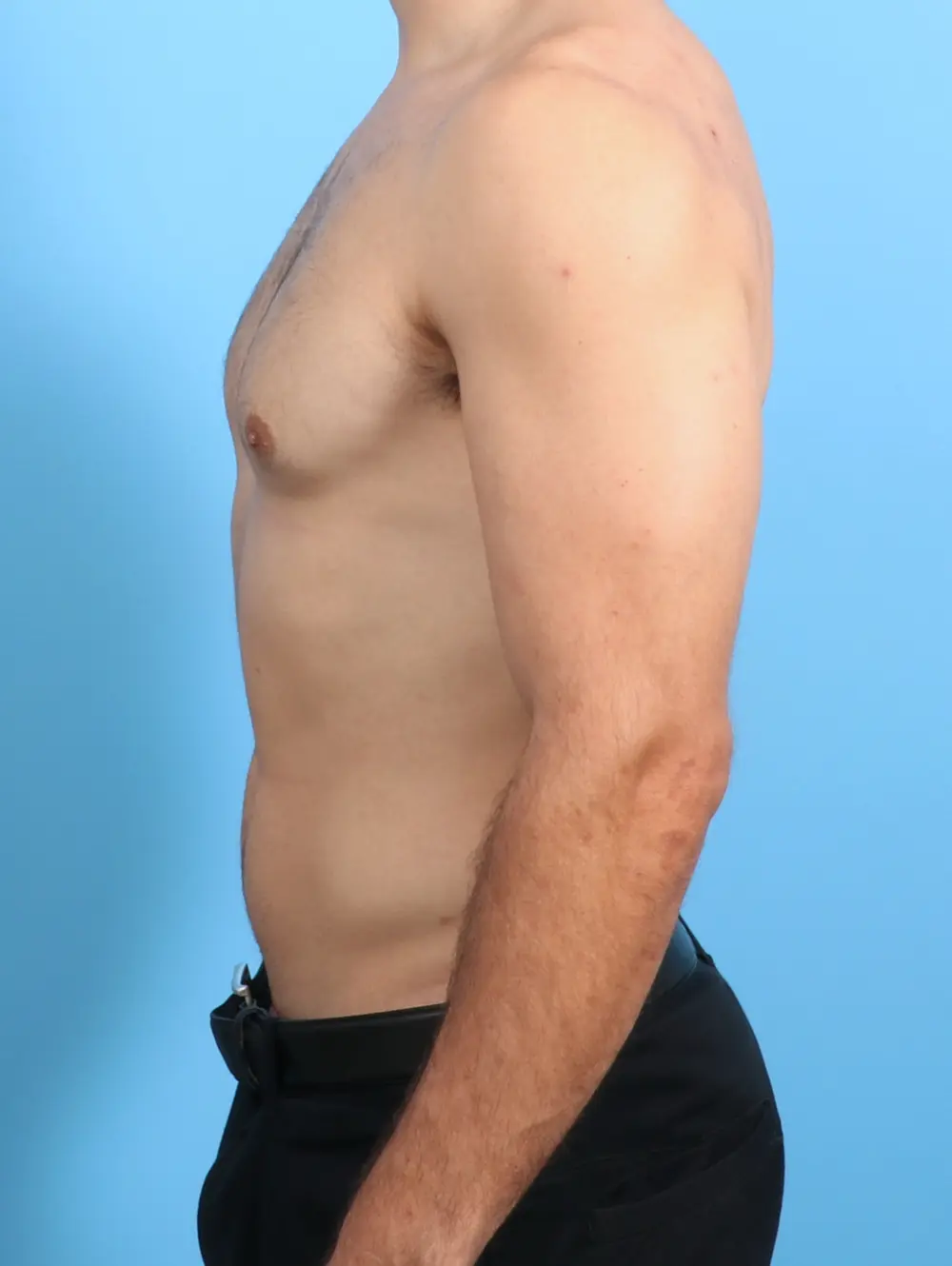 Gynecomastia Patient Photo - Case 27383 - before view-2