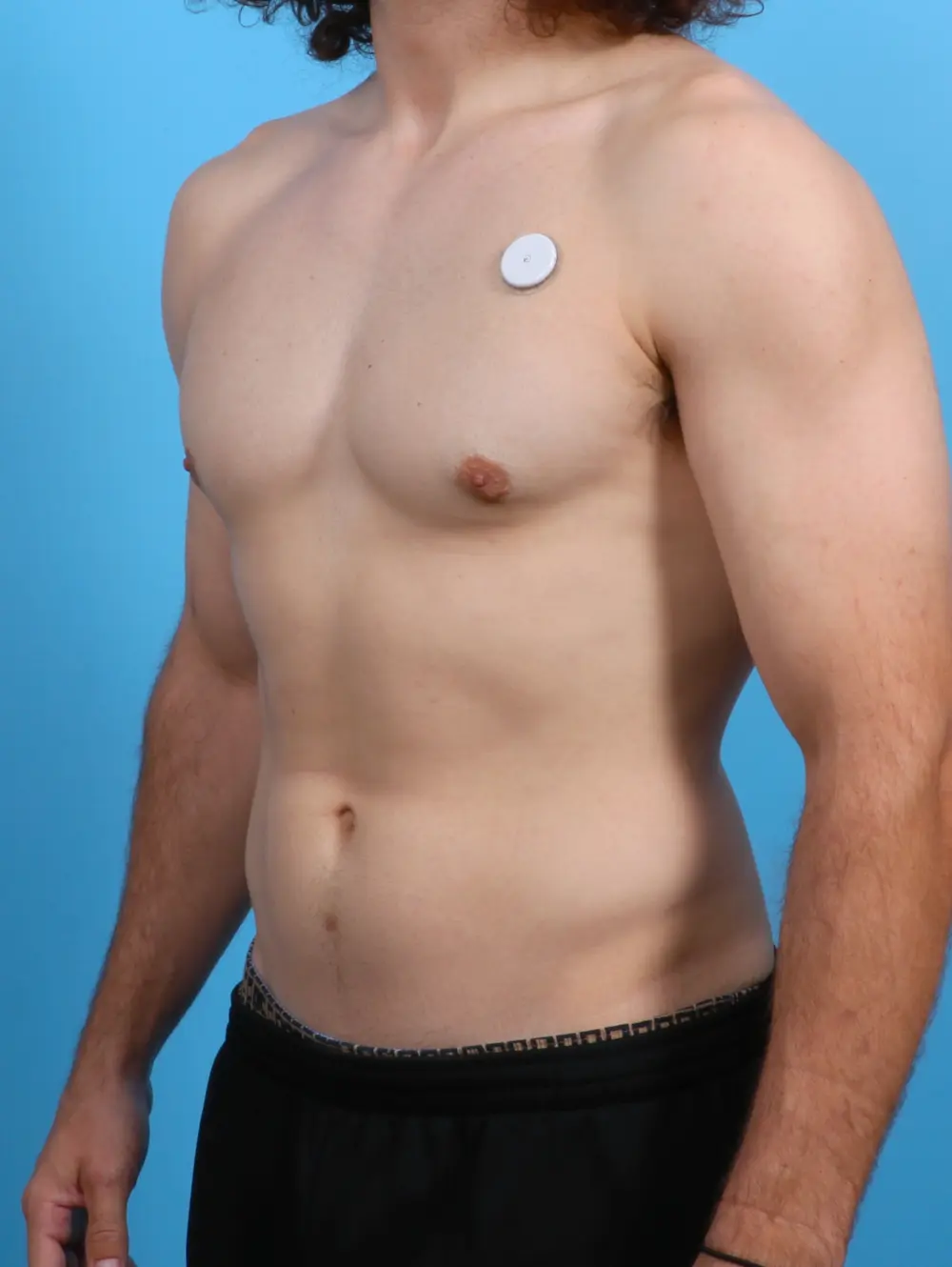 Gynecomastia Patient Photo - Case 27383 - after view-1