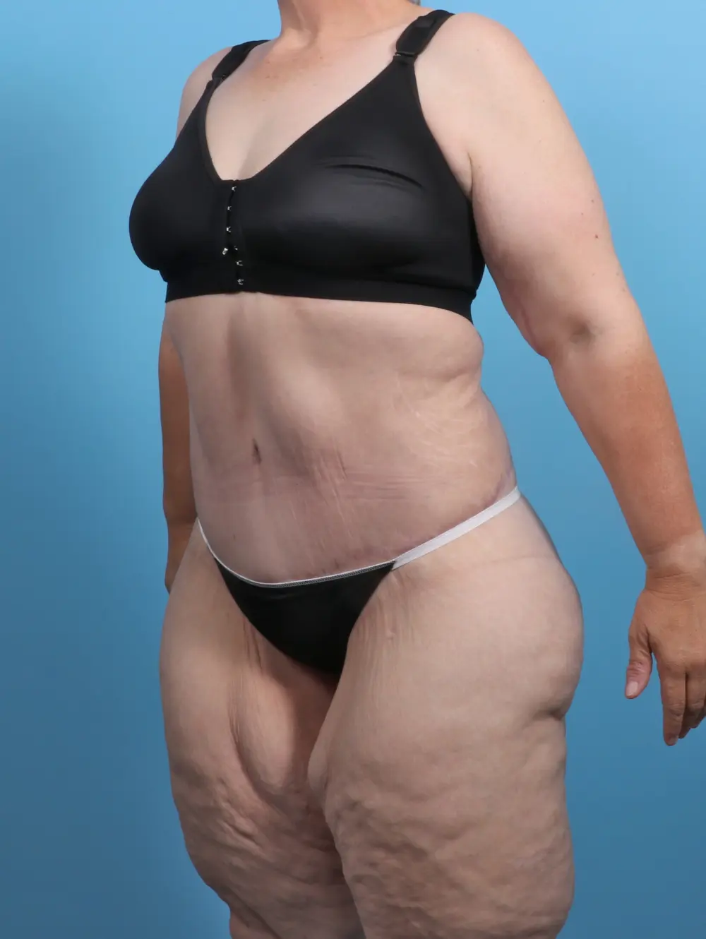 After Weight Loss Patient Photo - Case 27399 - after view-1