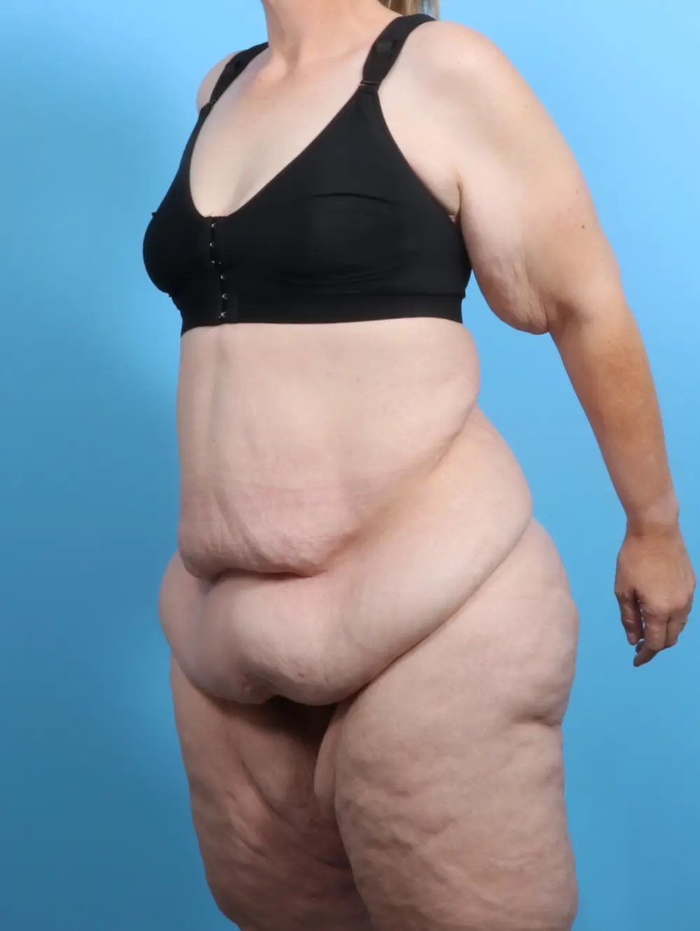 After Weight Loss Patient Photo - Case 27399 - before view-1