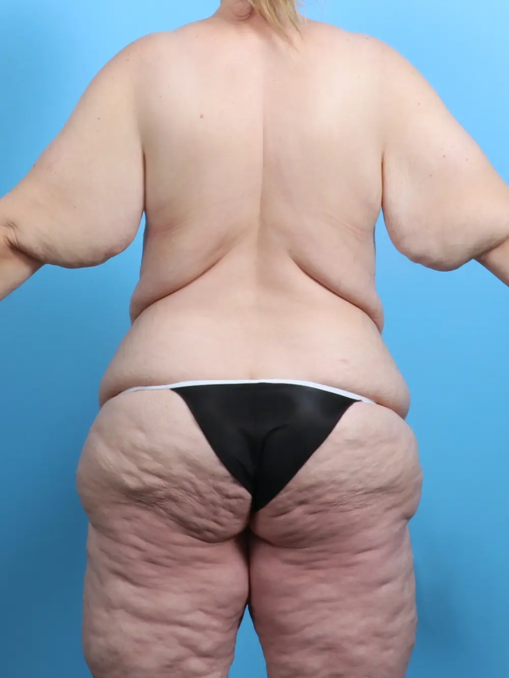 After Weight Loss Patient Photo - Case 27399 - before view-3