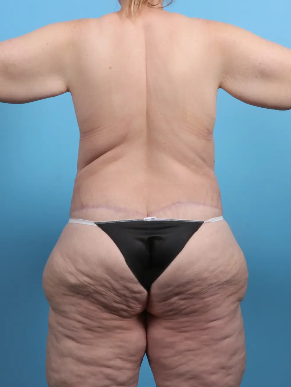 After Weight Loss Patient Photo - Case 27399 - after view-3