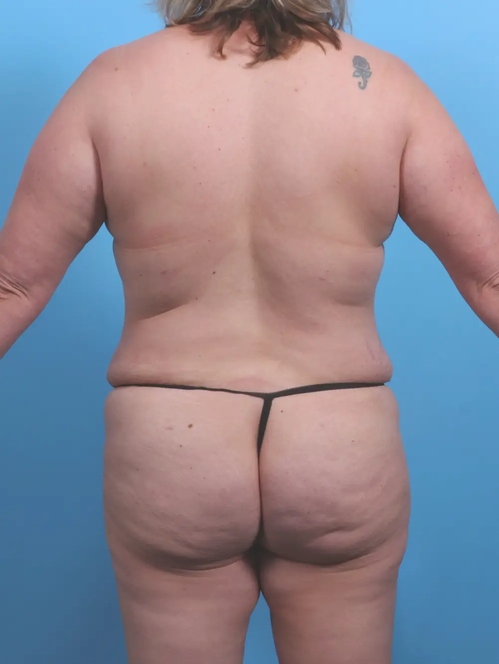 Tummy Tuck Patient Photo - Case 27432 - after view-3