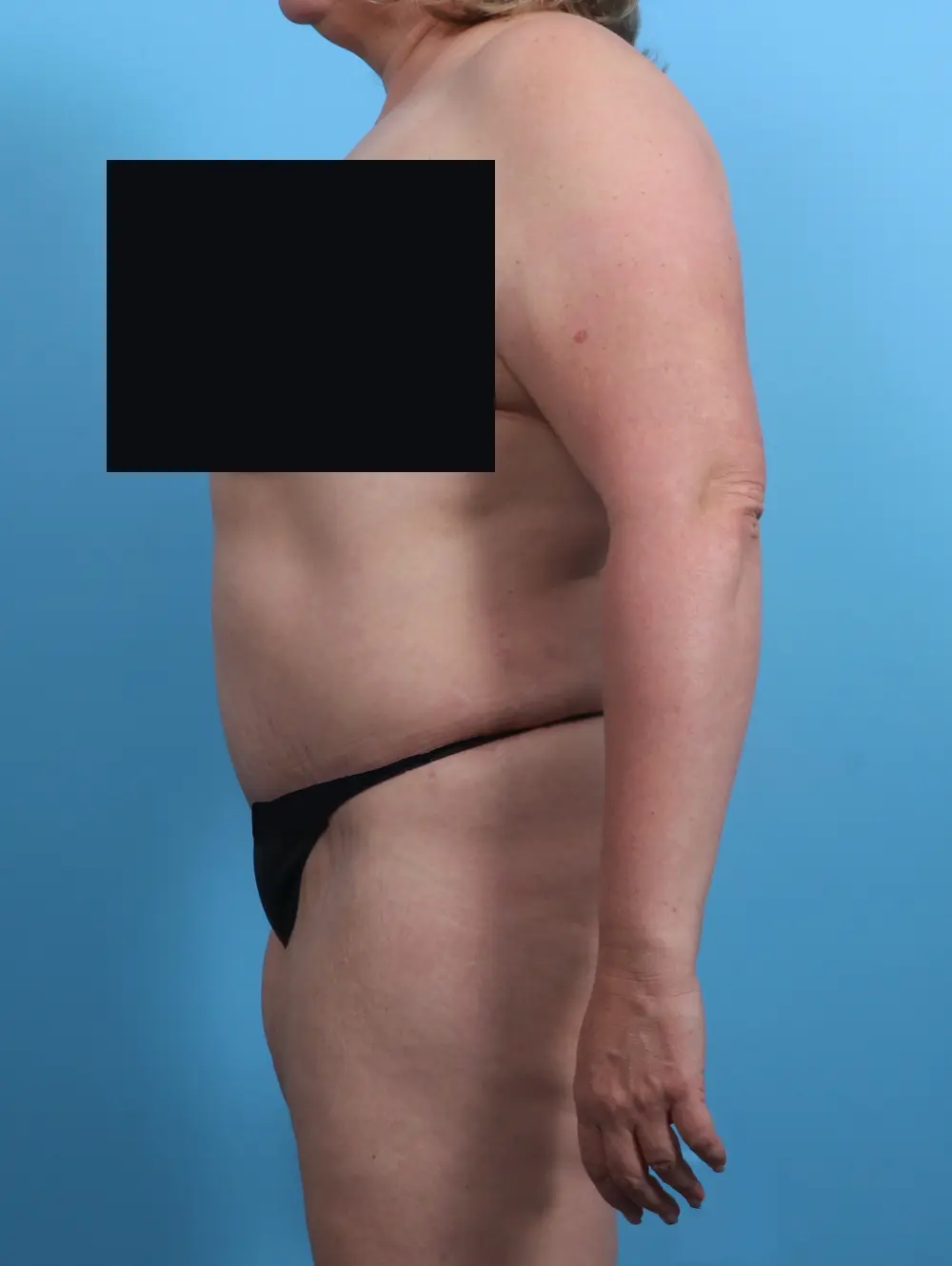 Tummy Tuck Patient Photo - Case 27432 - after view-2