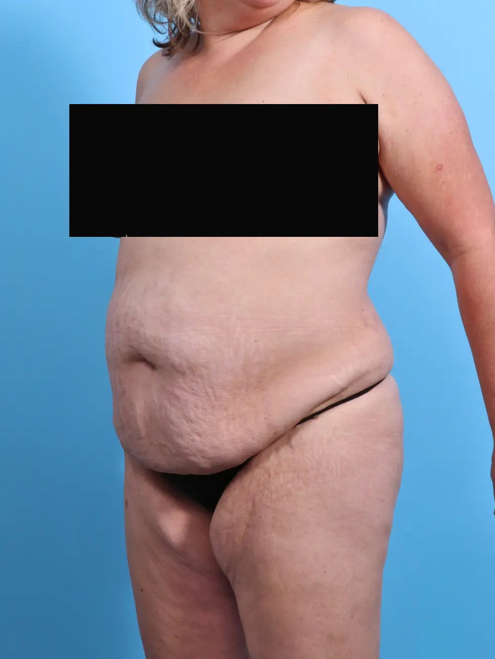 Tummy Tuck Patient Photo - Case 27432 - before view-1
