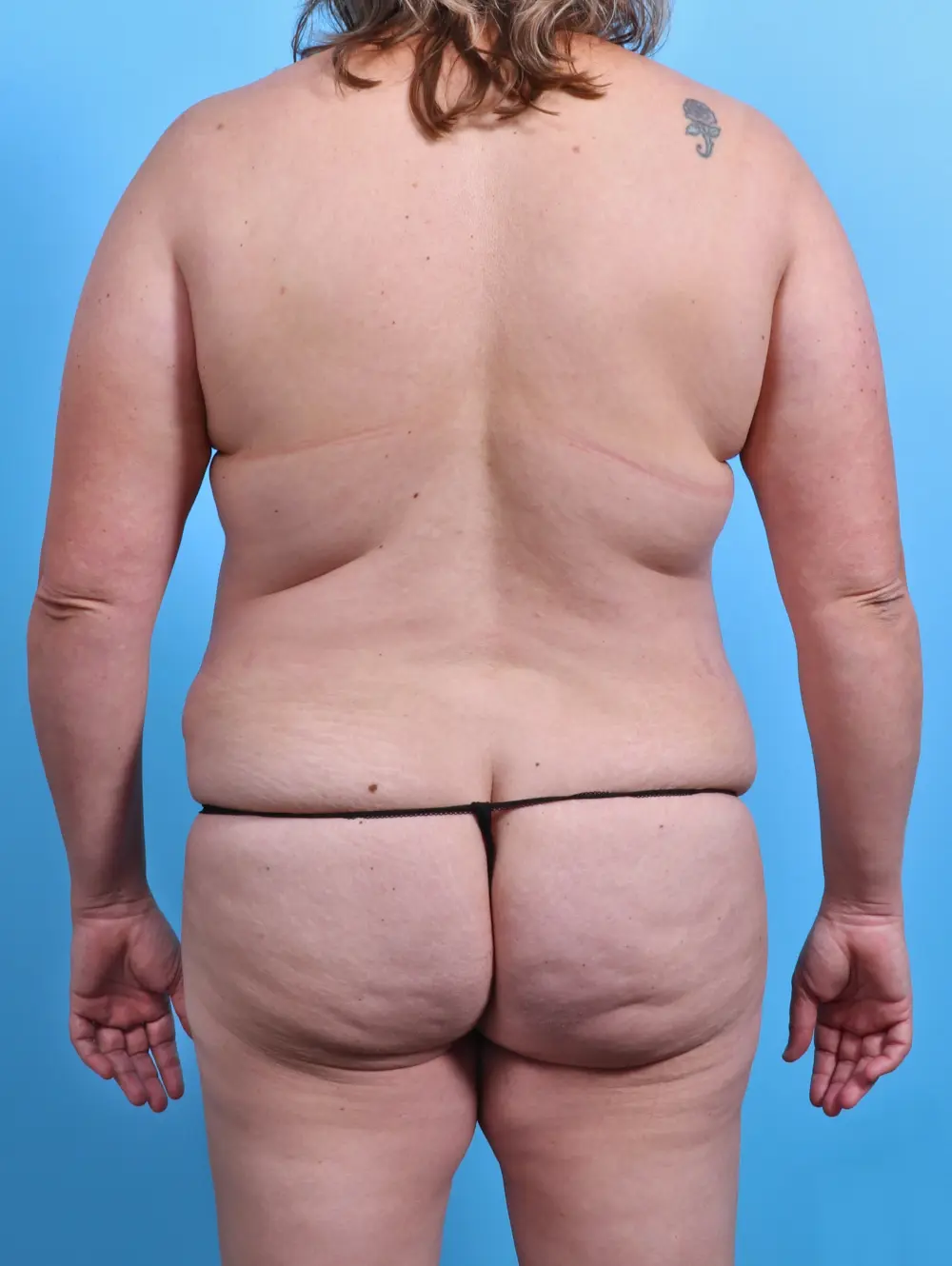Tummy Tuck Patient Photo - Case 27432 - before view-3