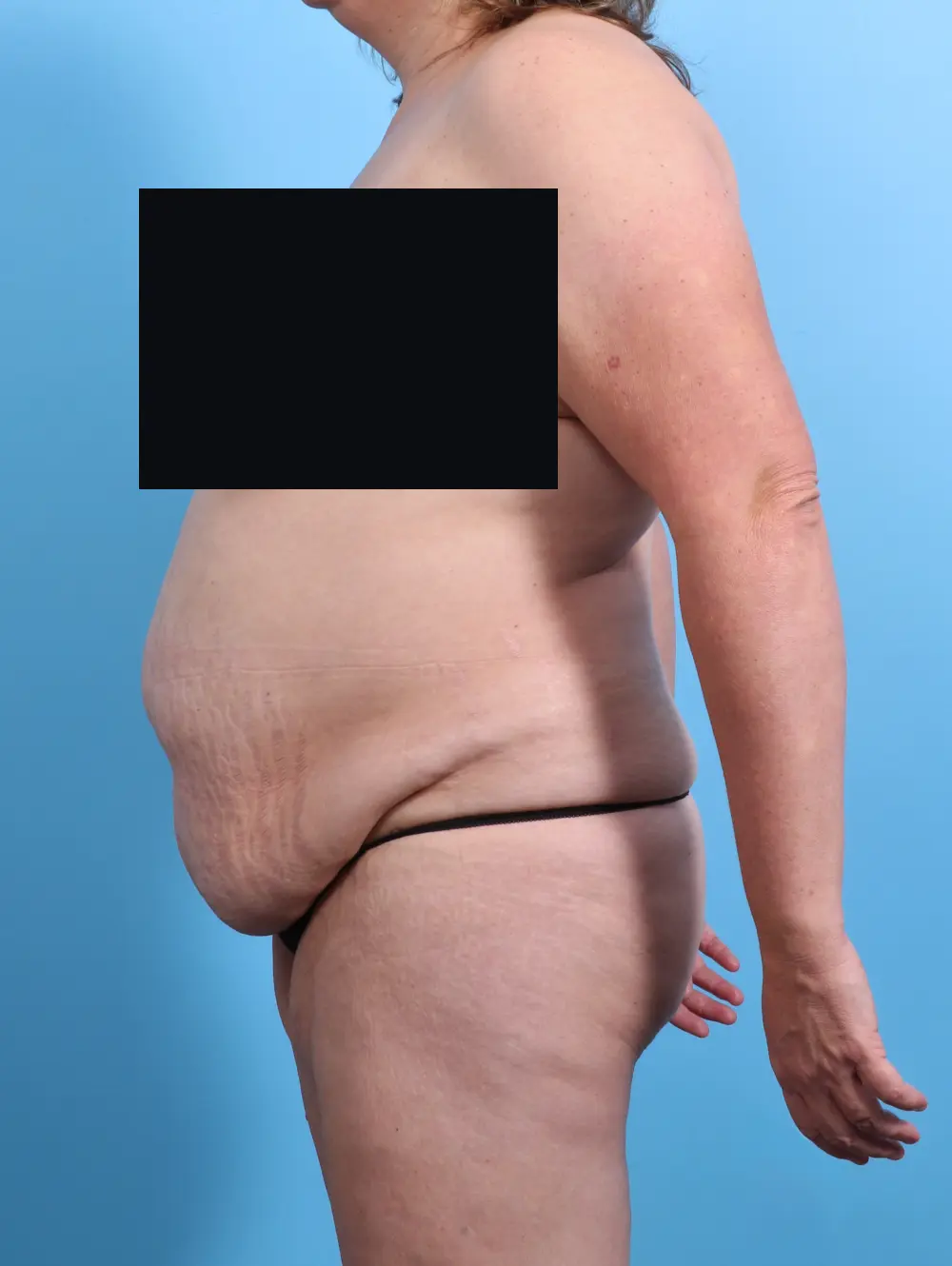 Tummy Tuck Patient Photo - Case 27432 - before view-2