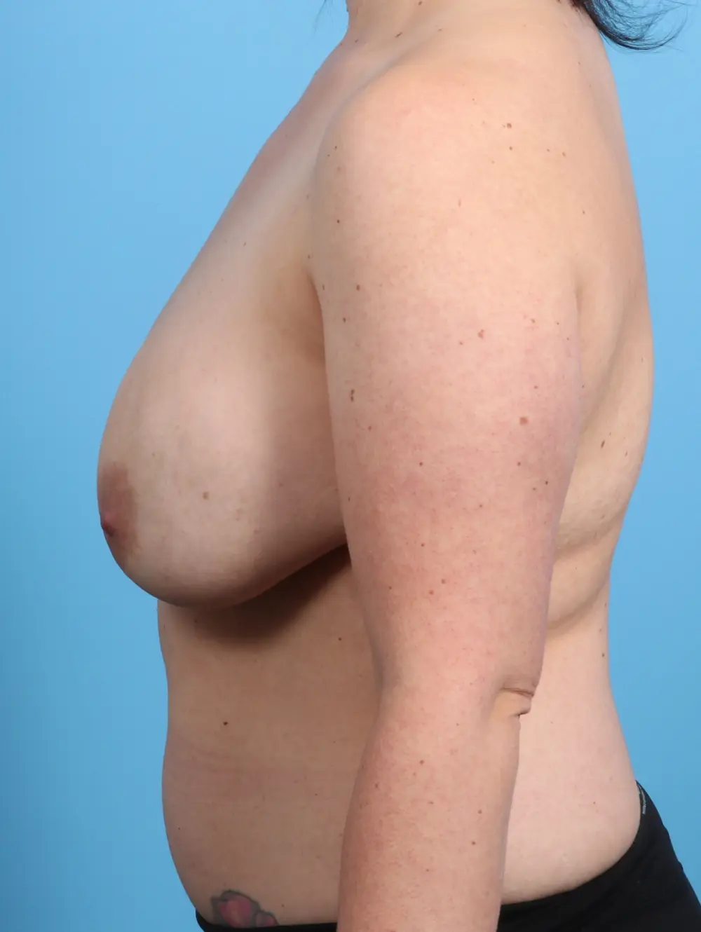 Breast Implant Revision Patient Photo - Case 27472 - before view-2