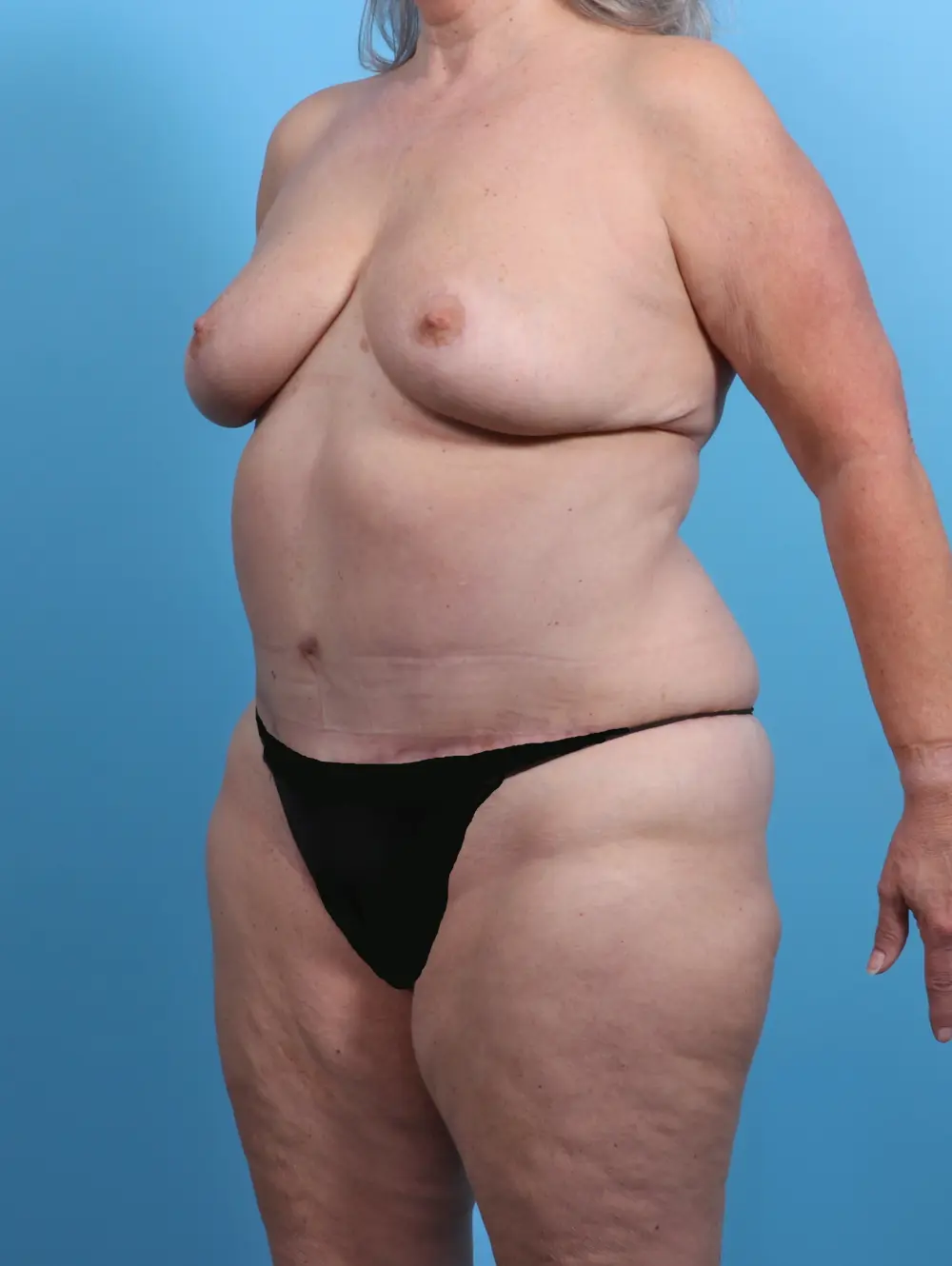 Breast Lift/Reduction w/o Implants Patient Photo - Case 27480 - after view-1