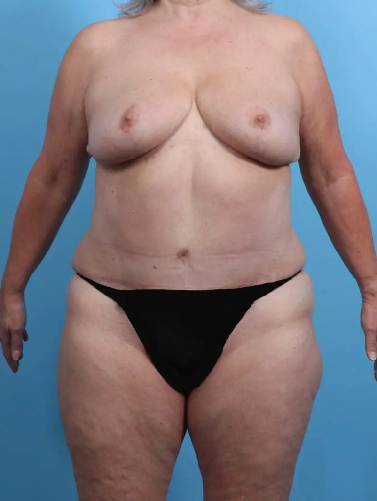 Breast Lift/Reduction w/o Implants - Case 27480 - After
