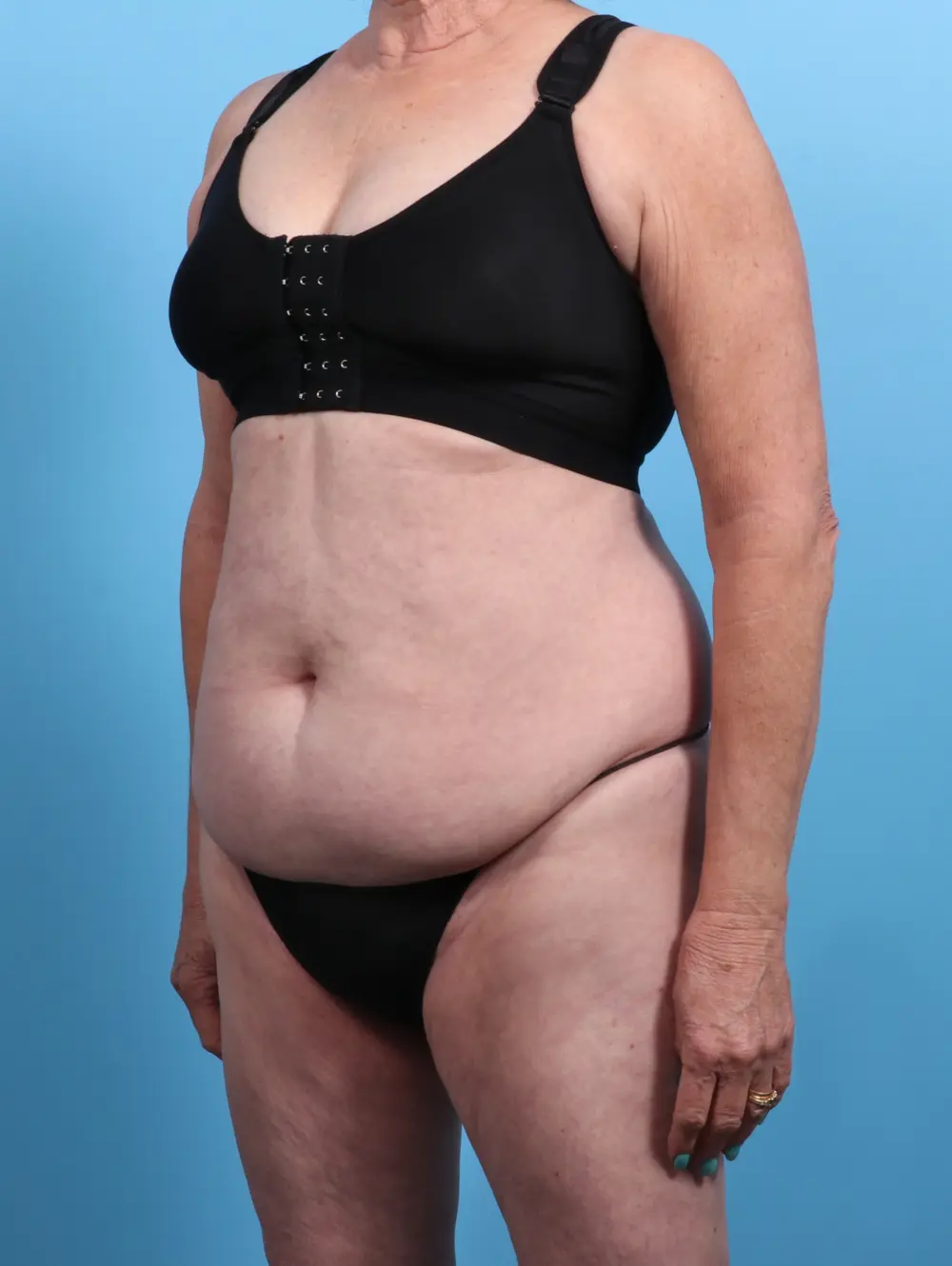Tummy Tuck Patient Photo - Case 27489 - before view-1