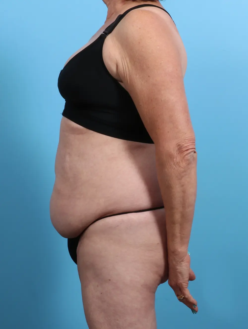 Tummy Tuck Patient Photo - Case 27489 - before view-2