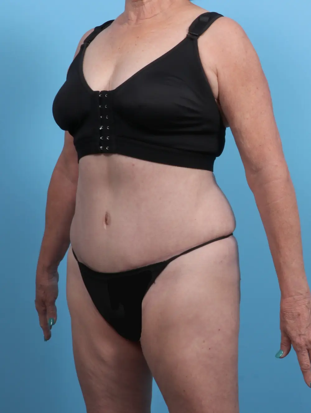 Tummy Tuck Patient Photo - Case 27489 - after view-1