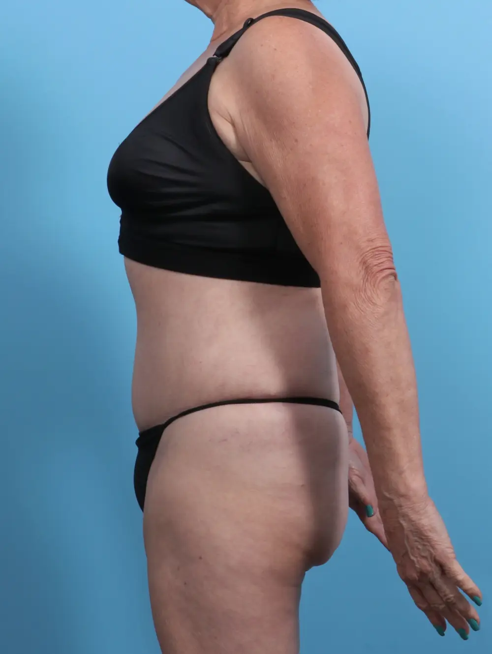 Tummy Tuck Patient Photo - Case 27489 - after view-2