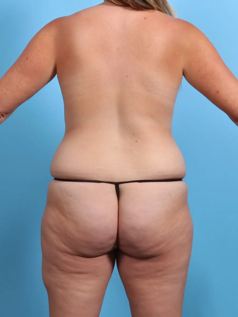 Fat Transfer Patient Photo - Case 27497 - before view-3