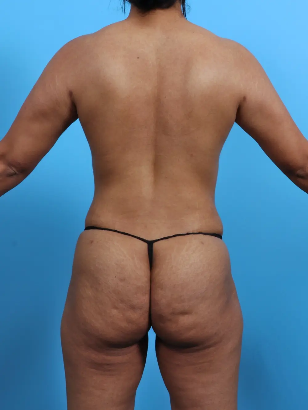 Breast Lift/Reduction w/o Implants Patient Photo - Case 27540 - after view-3