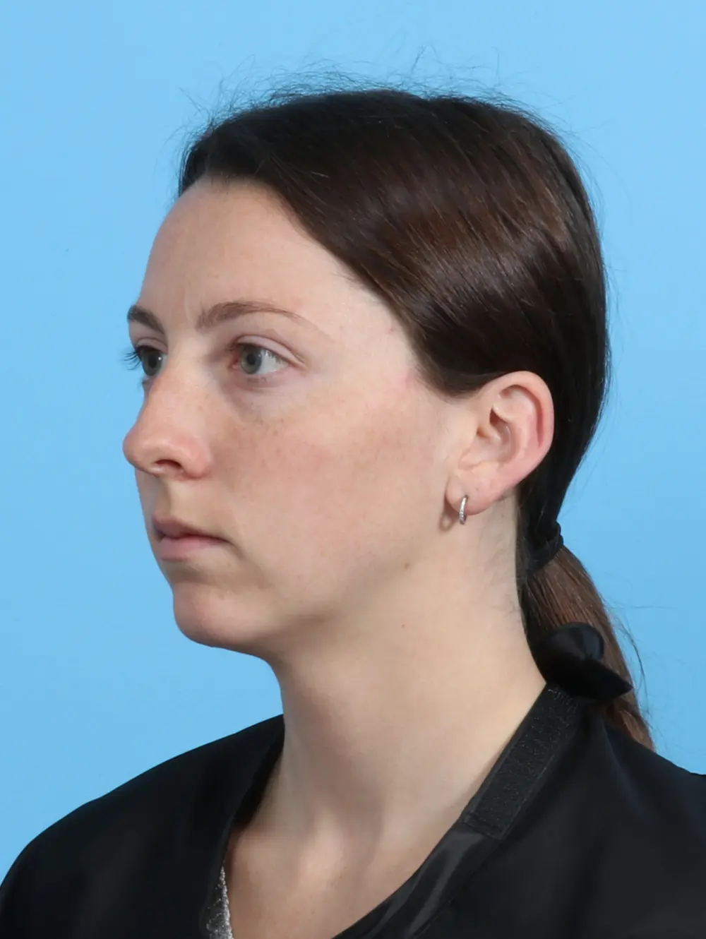 Chin Implant Patient Photo - Case 27550 - before view-1